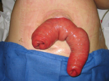 Stoma Prolapse